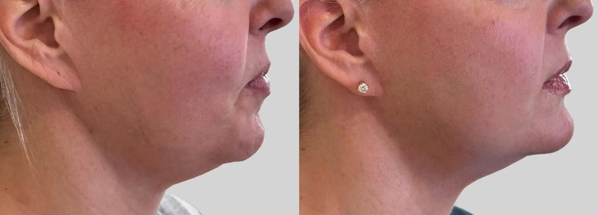 Lower Face Dermal Filler (2)