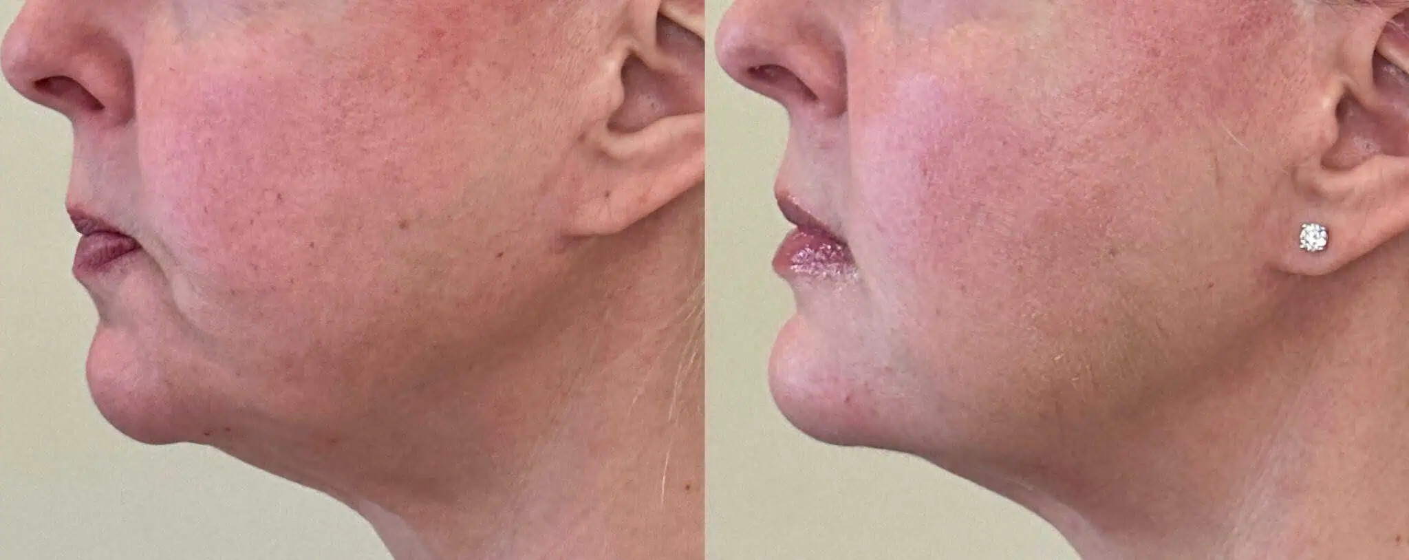 Lower Face Dermal Filler (3)