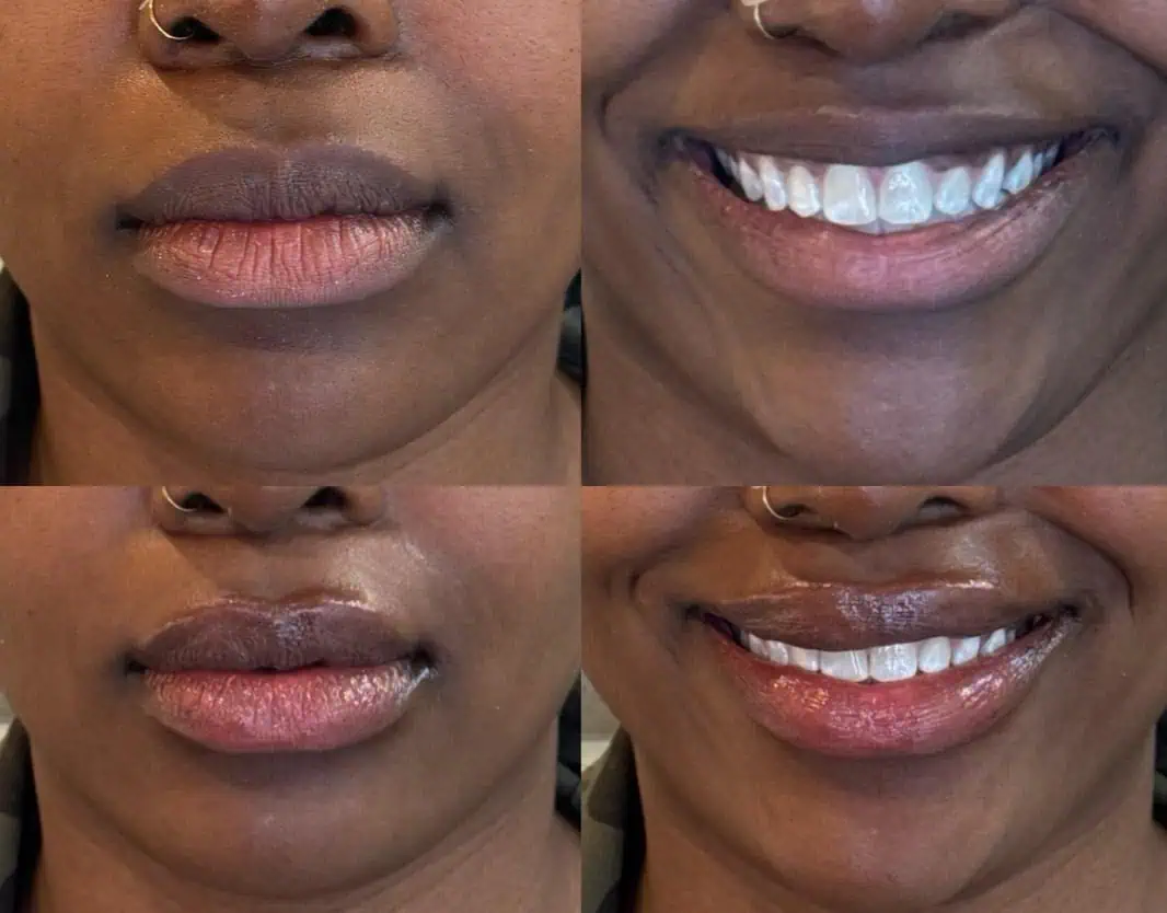 Signature Lip Filler with Under Eye Dissolving (1)