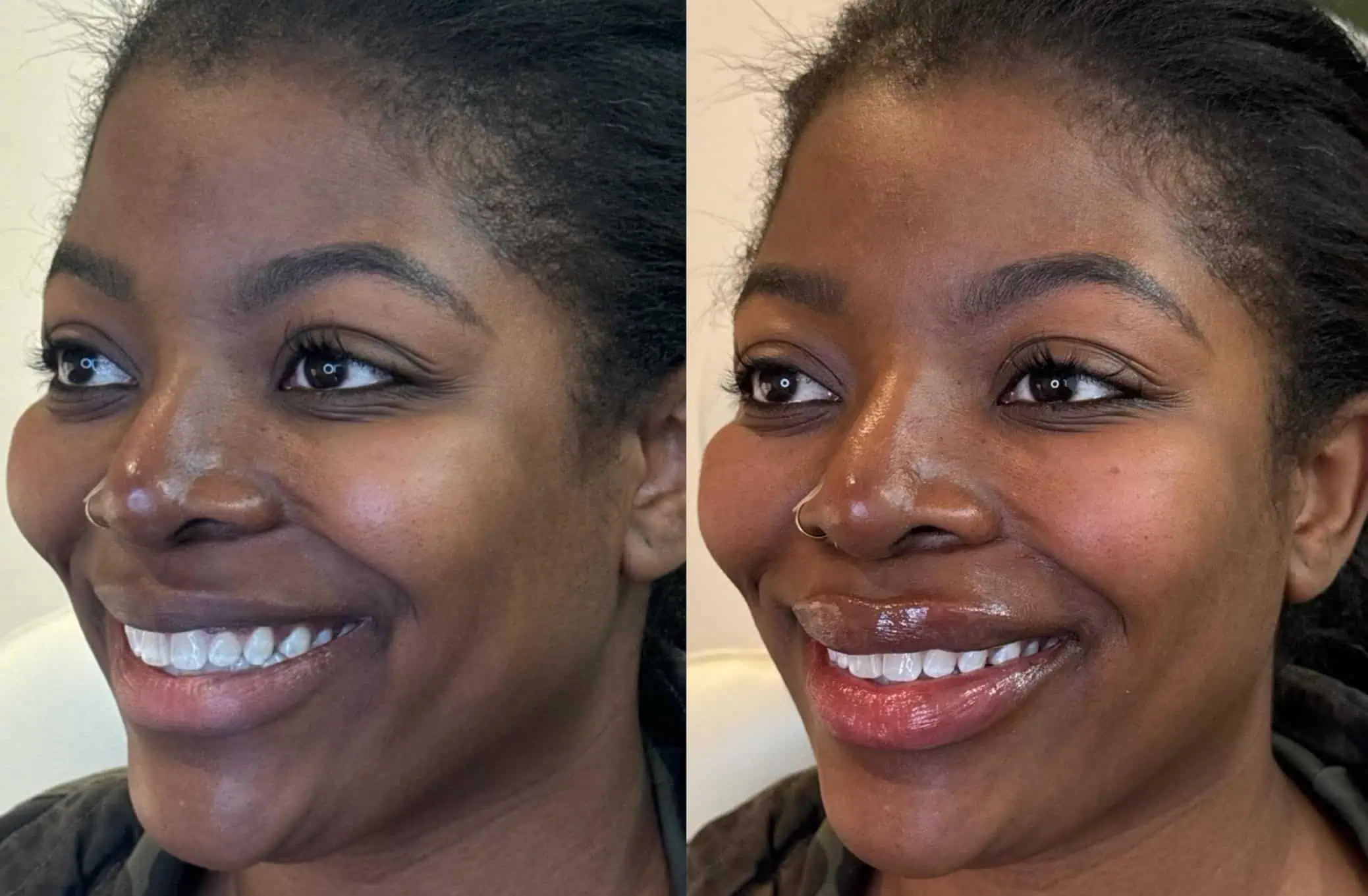 Signature Lip Filler with Under Eye Dissolving (2)