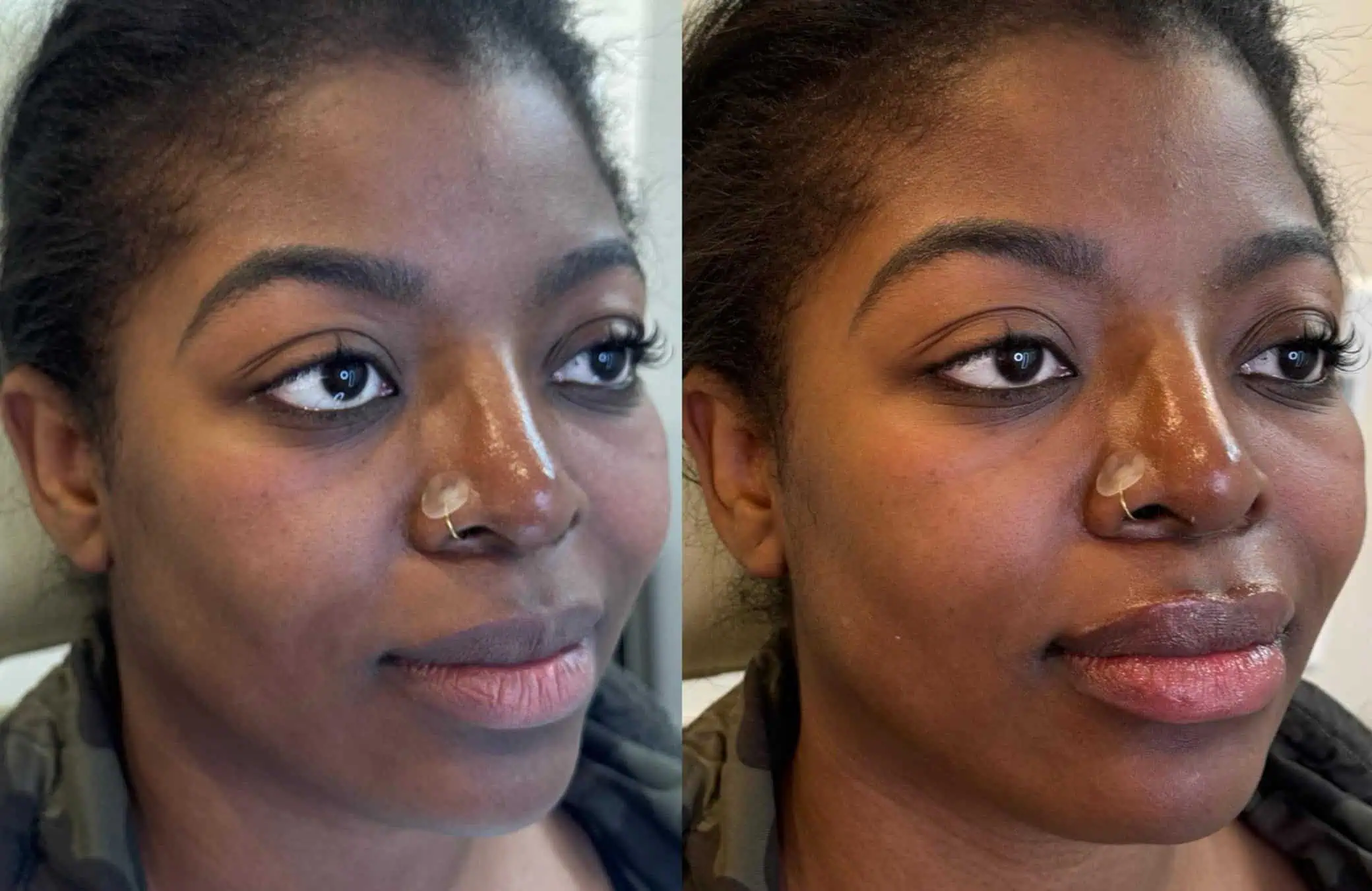 Signature Lip Filler with Under Eye Dissolving (3)