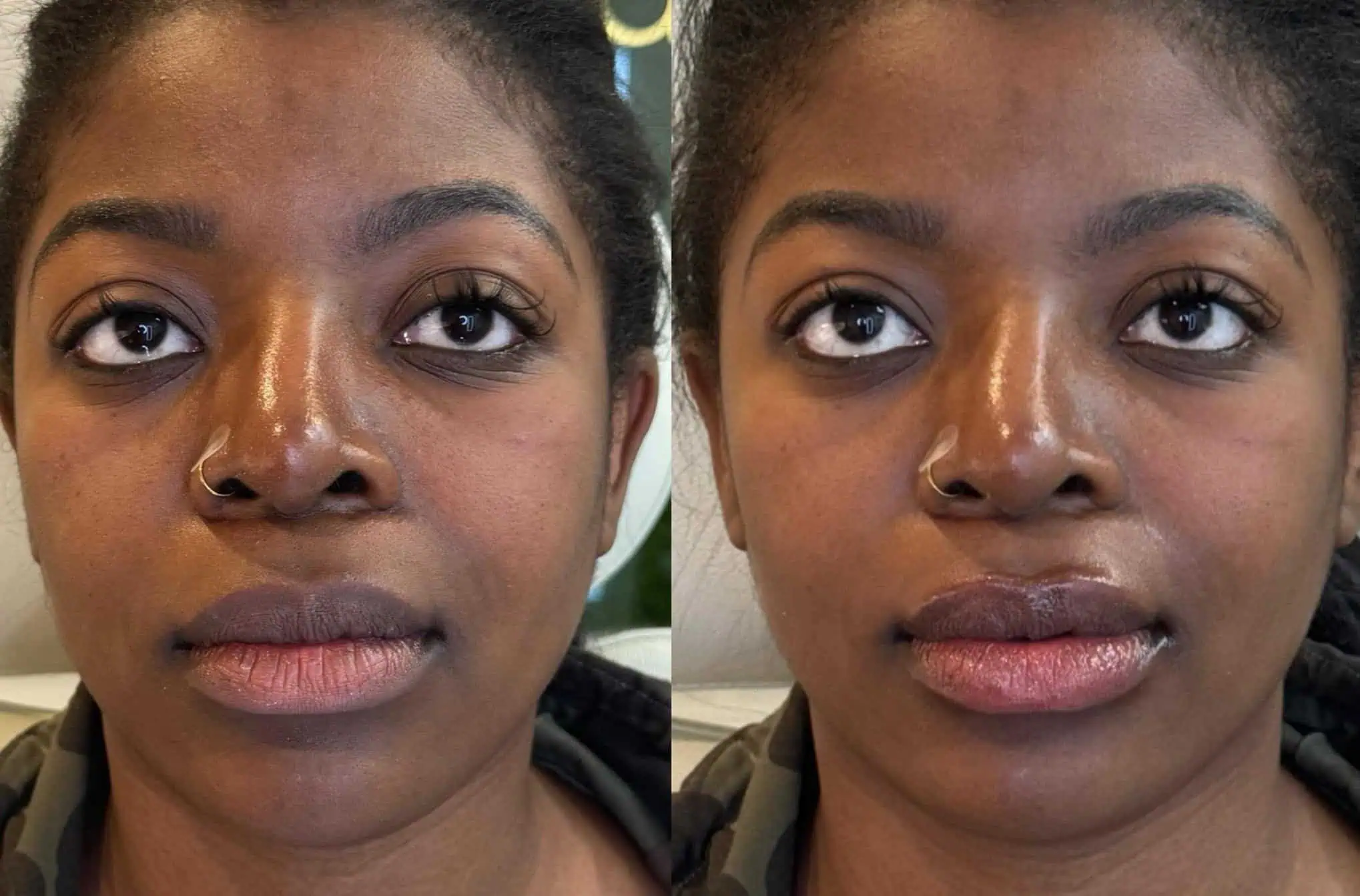 Signature Lip Filler with Under Eye Dissolving (4)