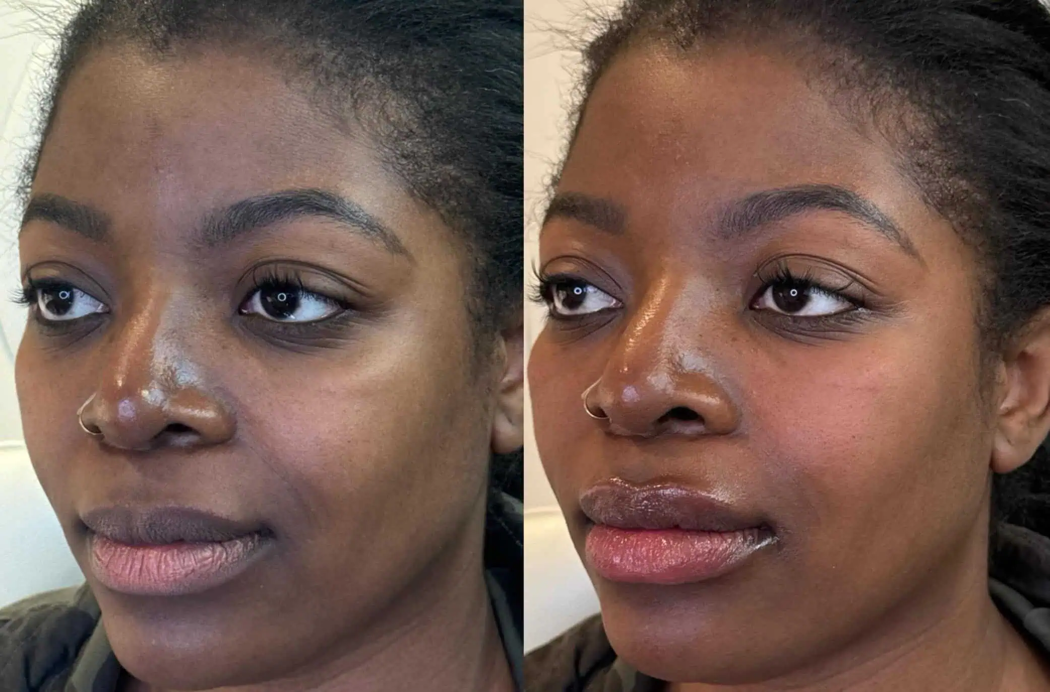 Signature Lip Filler with Under Eye Dissolving (5)