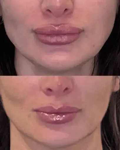 Signature Lip Filler_ Dissolving and Refilling