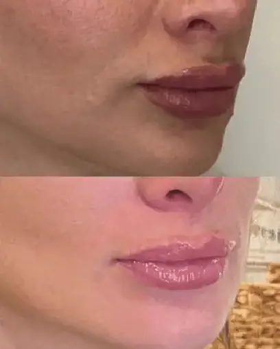 Signature Lip Filler_ Dissolving and Refilling2