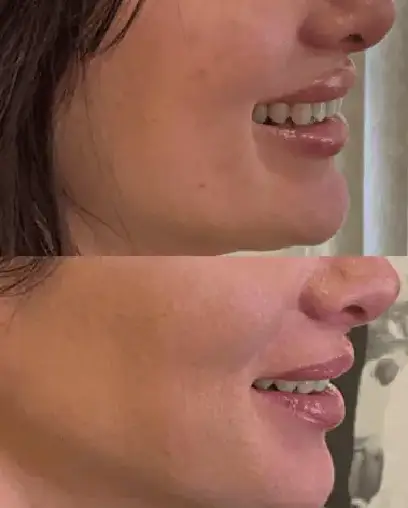 Signature Lip Filler_ Dissolving and Refilling3