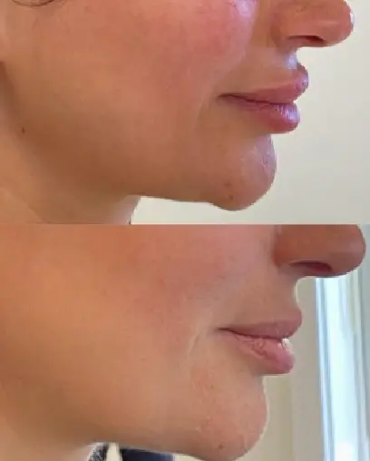 Signature Lip Filler_ Dissolving and Refilling4