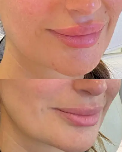 Signature Lip Filler_ Dissolving and Refilling5