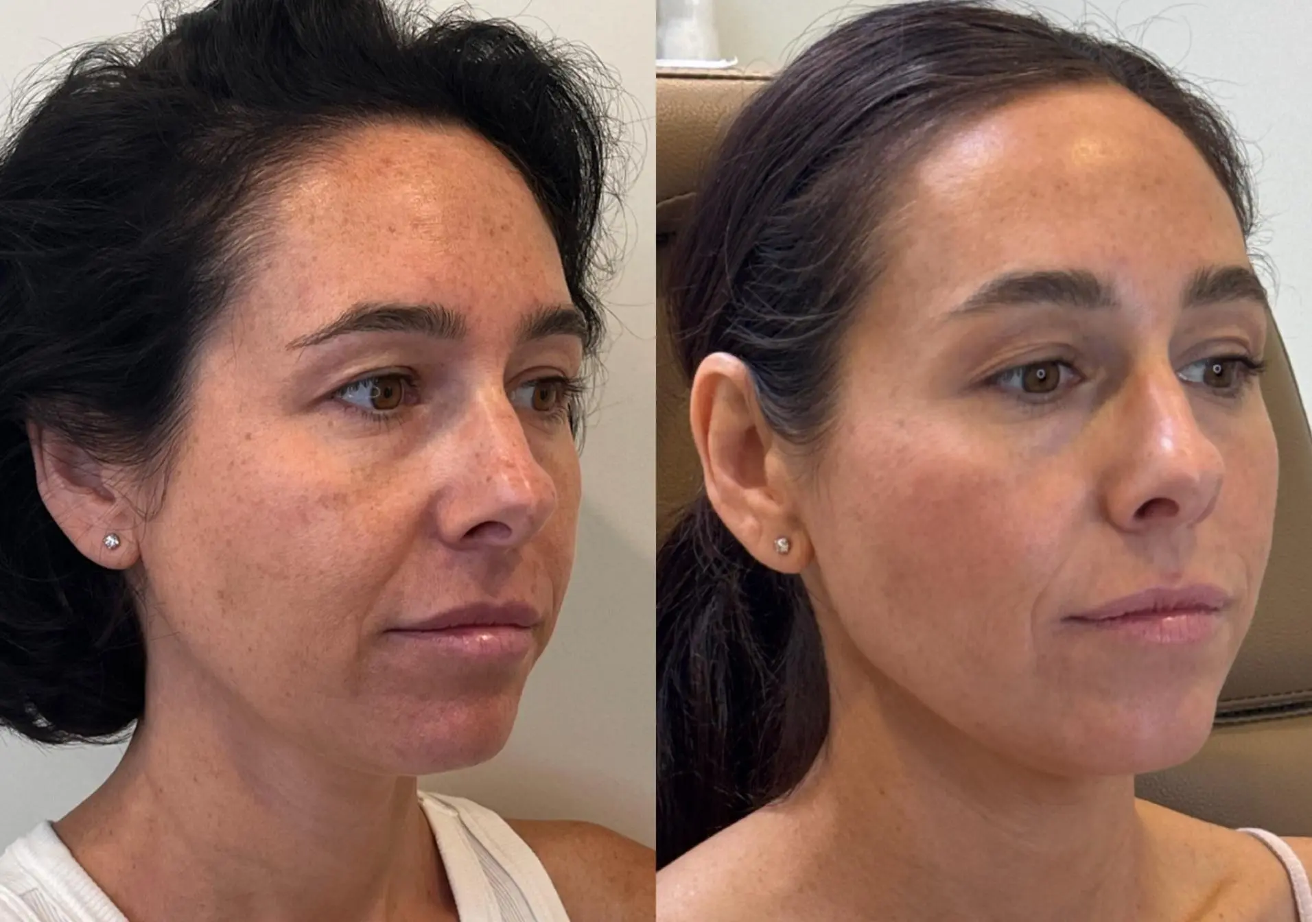 Sculptra with Full Face Neurotoxin