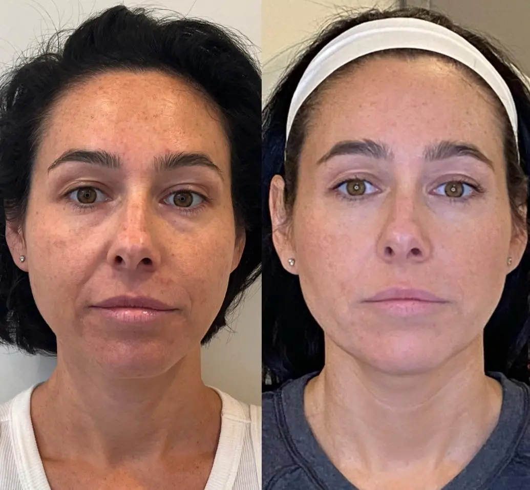 Sculptra with Full Face Neurotoxin