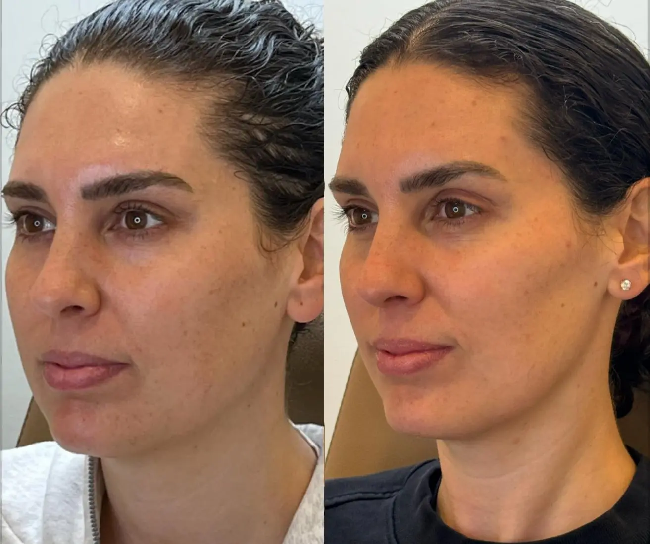Sculptra with Full Face Neurotoxin