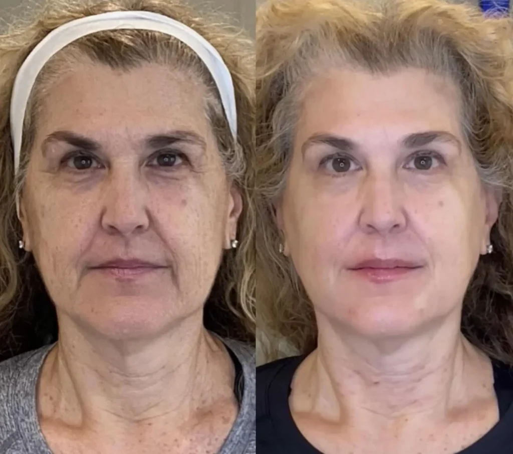 Sculptra with Full Face Neurotoxin, Signature Lip Filler, and Lower Face Dermal Filler
