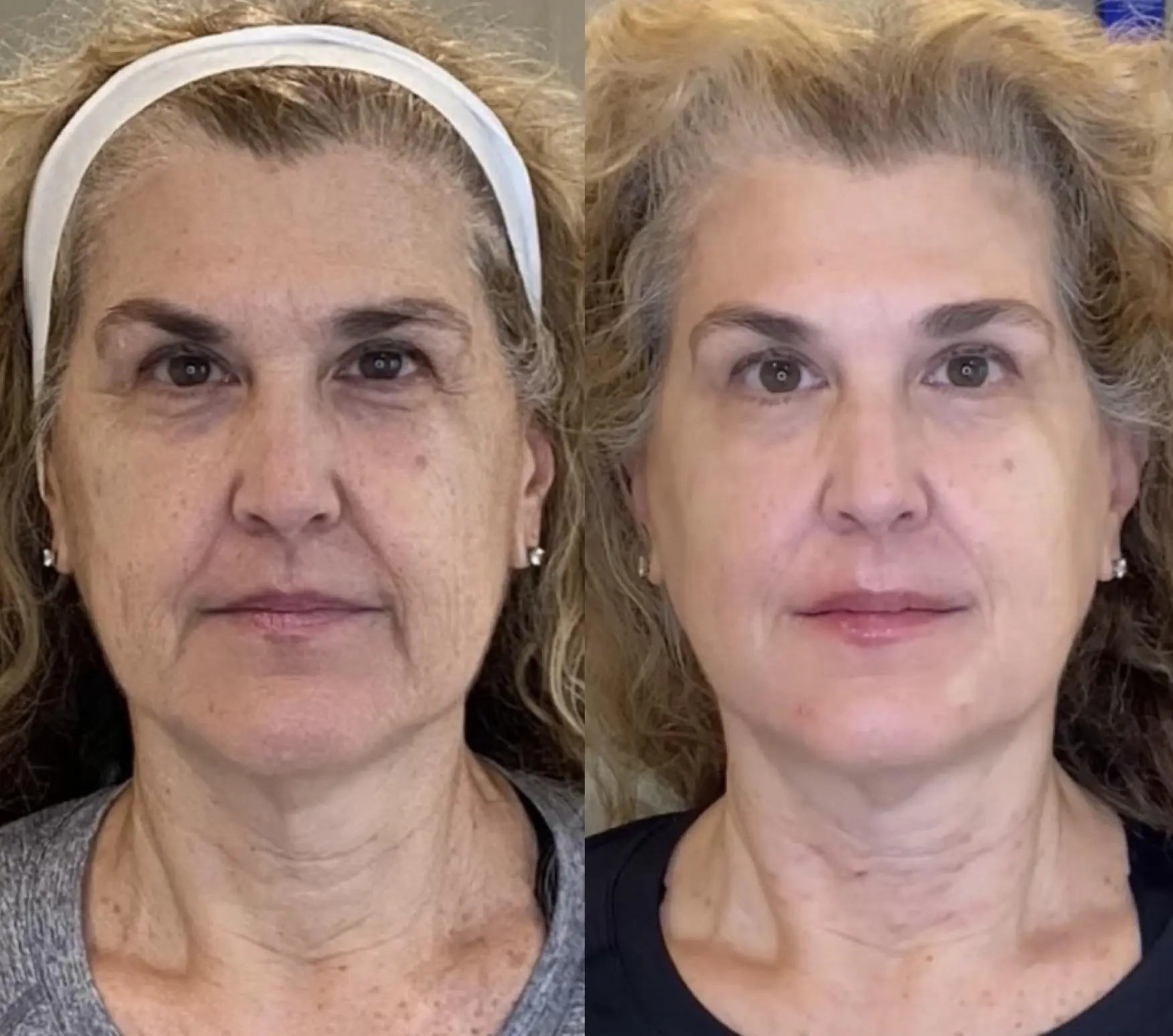 Sculptra with Full Face Neurotoxin