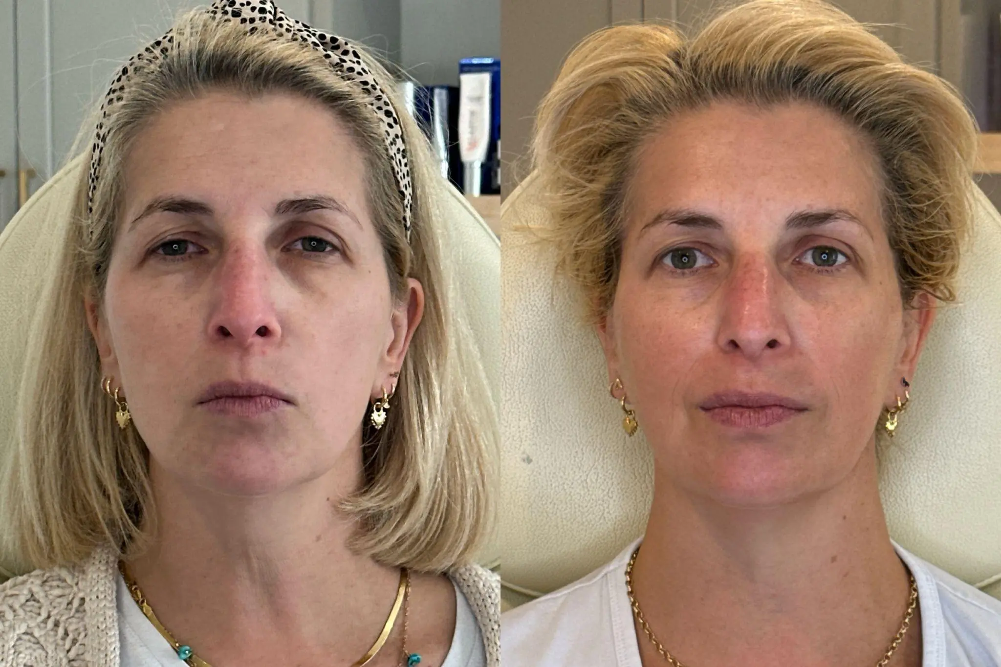 Sculptra before and after