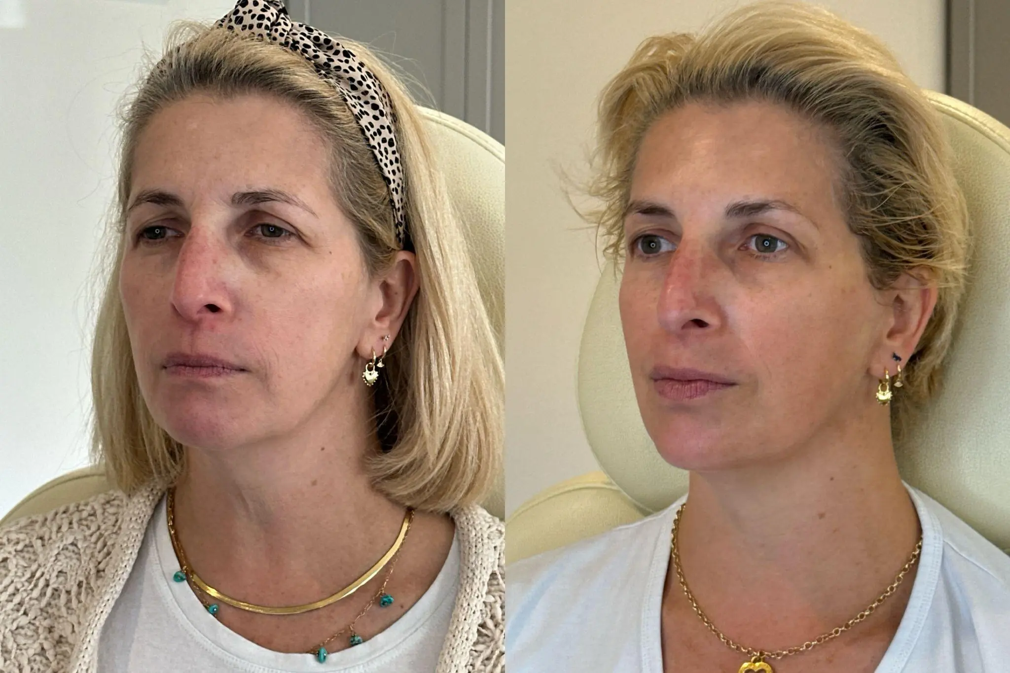 Sculptra before and after