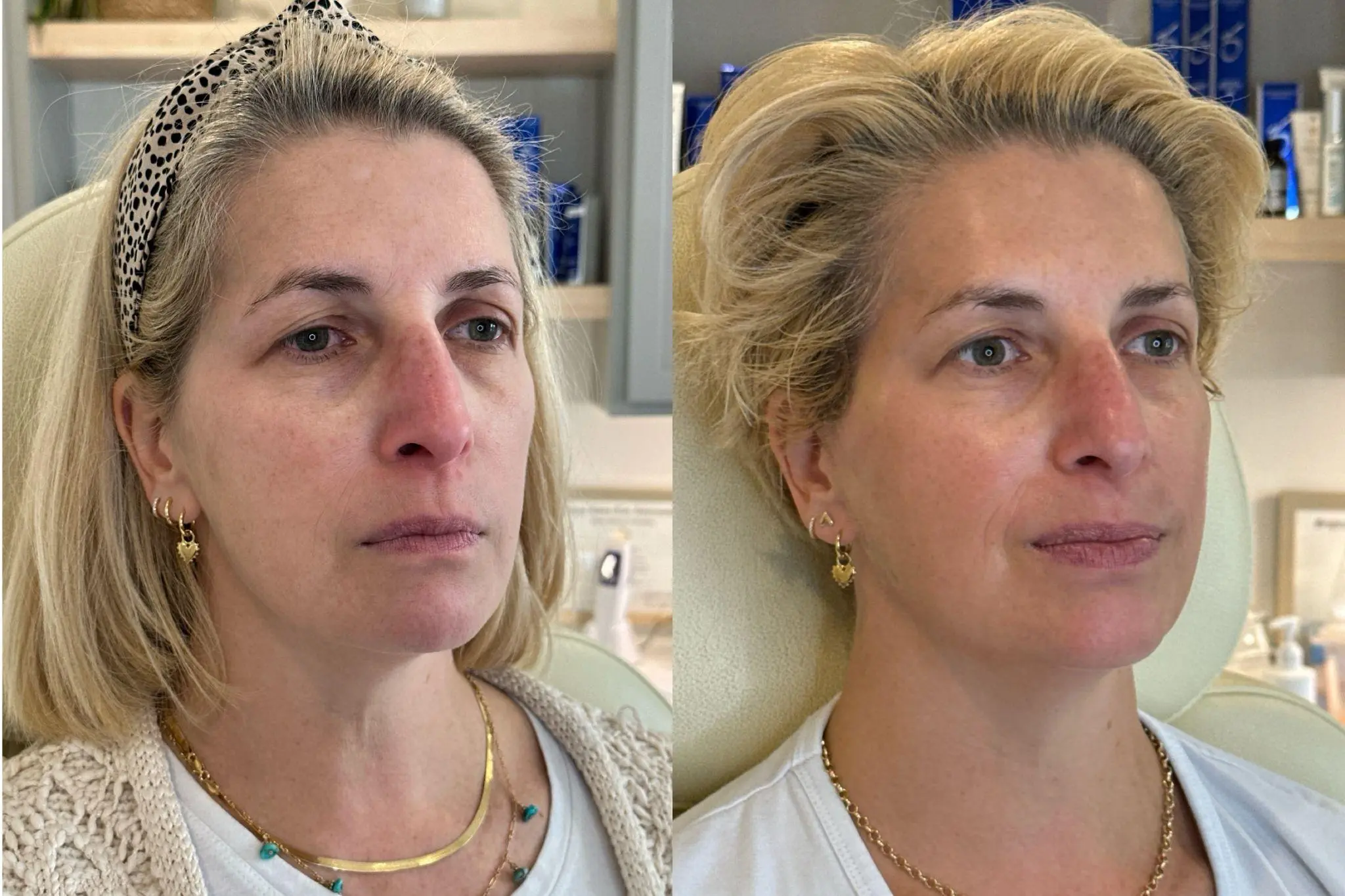 Sculptra before and after