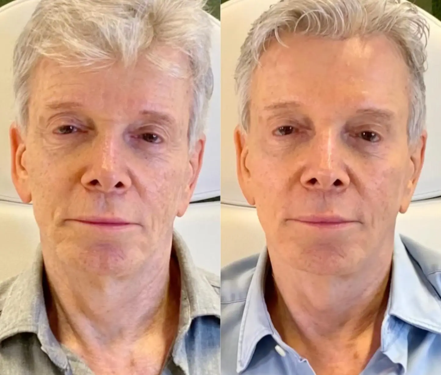 Sculptra with Full Face Neurotoxin