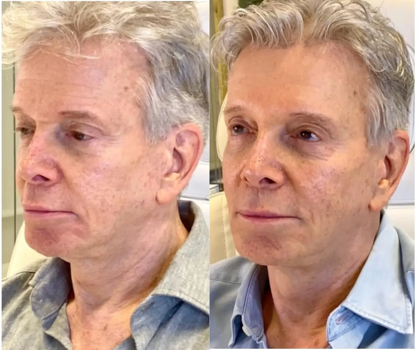 Sculptra with Full Face Neurotoxin