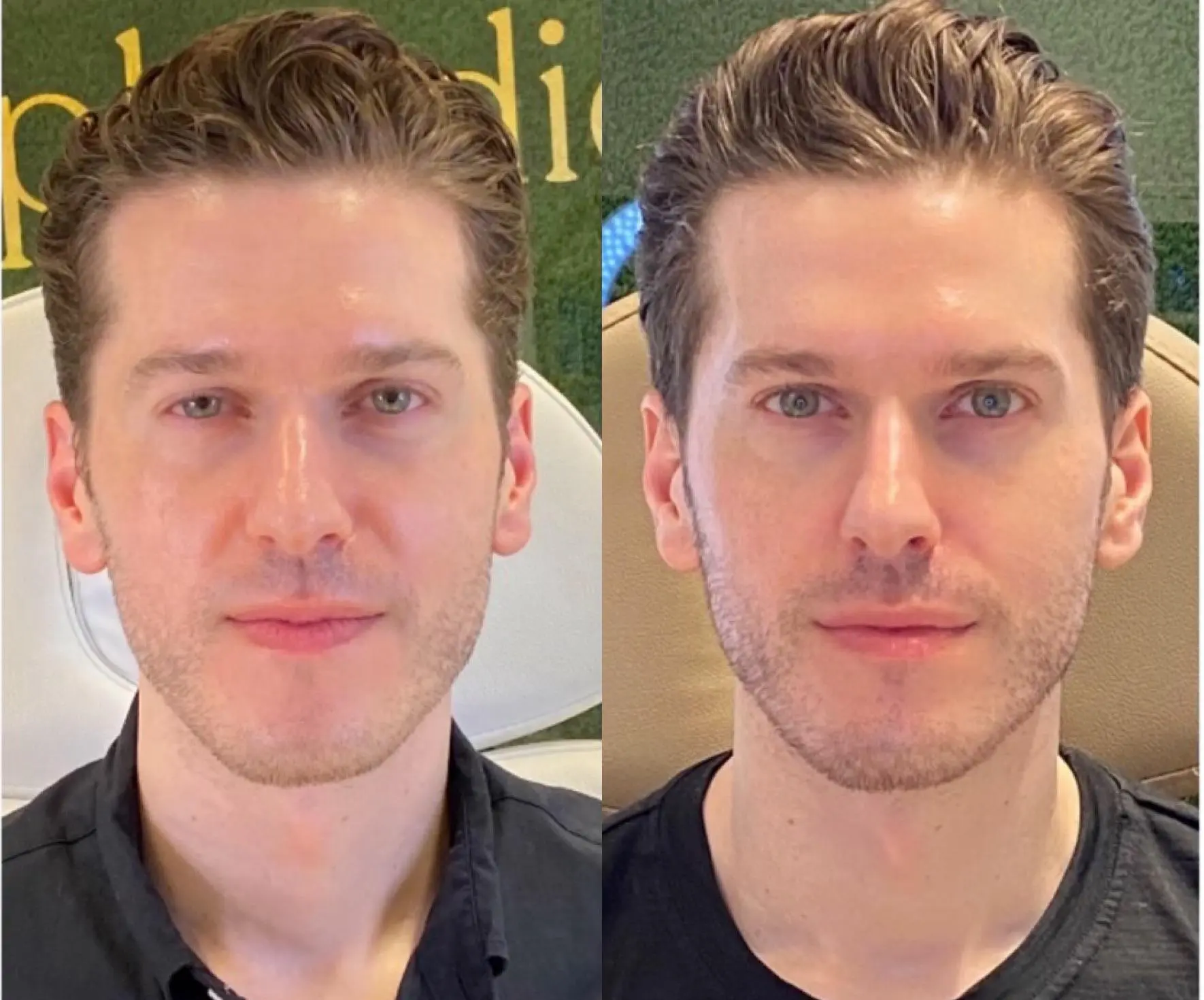 Full Face Neurotoxin