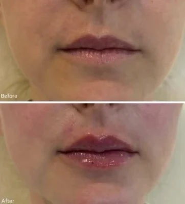 Signature Lip Filler (1)