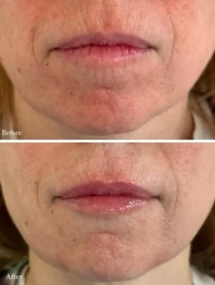 Signature Lip Filler (2)