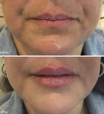 Signature Lip Filler (3)