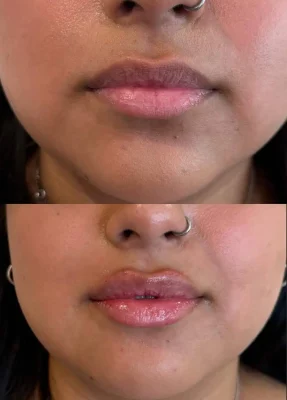 Signature Lip Filler (5)