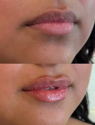 Signature Lip Filler (6)