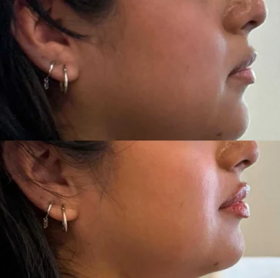 Signature Lip Filler (7)