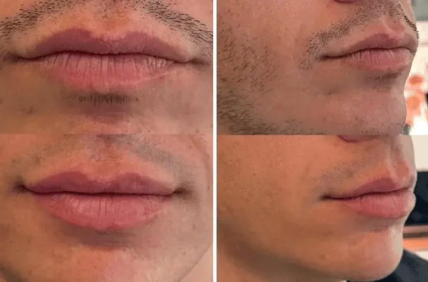 Signature Lip Filler (8)