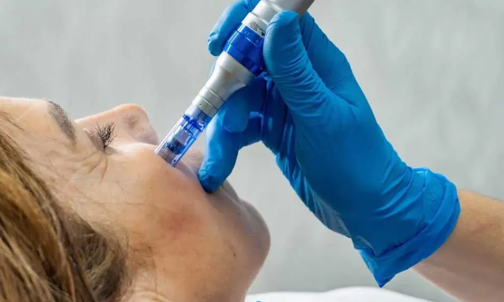 SkinPen Microneedling at SkinSplendid in New York, NY